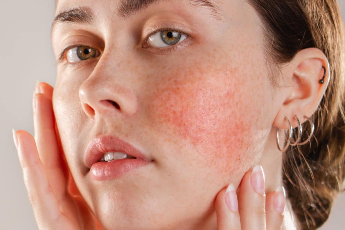 Rosacea:  Definition, Symptoms, Triggers, and Treatment