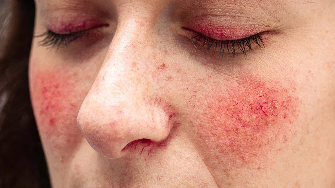 5 Basic Yet Critical Skin Care Tips for Rosacea