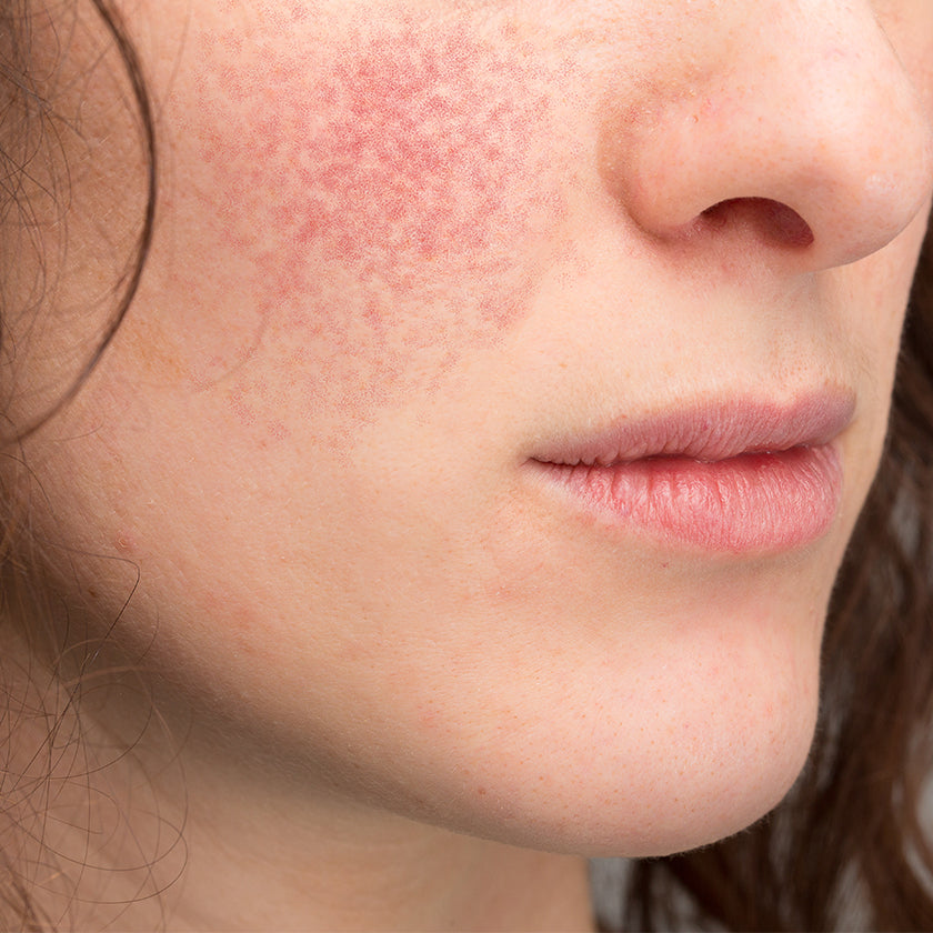 Rosacea Skin and Hair Care
